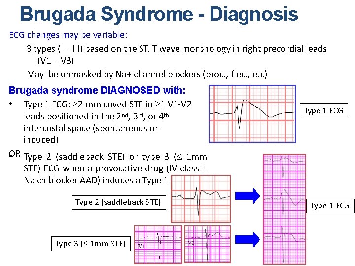 Brugada Syndrome - Diagnosis ECG changes may be variable: 3 types (I – III)