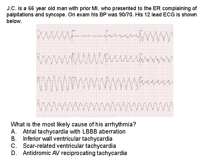 J. C. is a 66 year old man with prior MI, who presented to