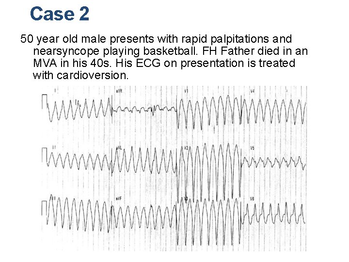 Case 2 50 year old male presents with rapid palpitations and nearsyncope playing basketball.