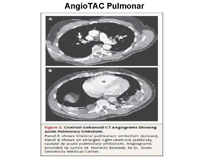 Angio. TAC Pulmonar 