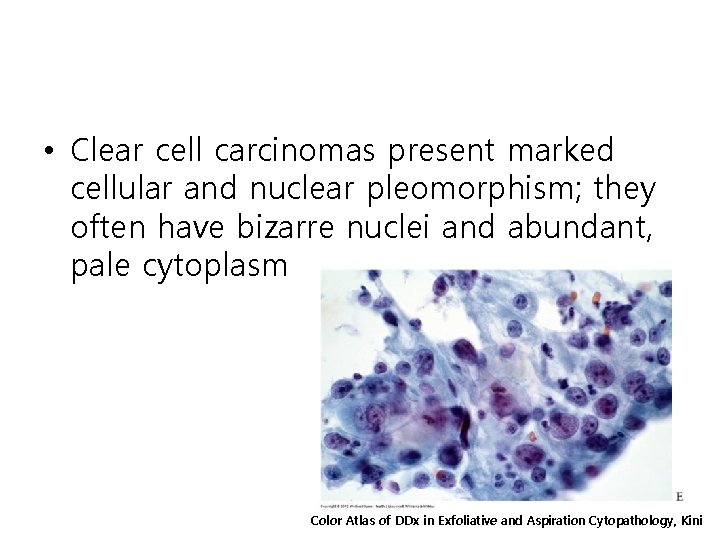  • Clear cell carcinomas present marked cellular and nuclear pleomorphism; they often have