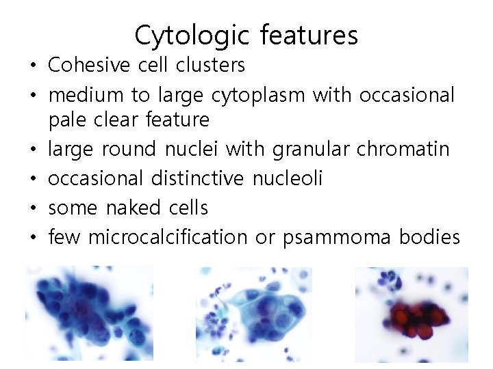 Cytologic features • Cohesive cell clusters • medium to large cytoplasm with occasional pale