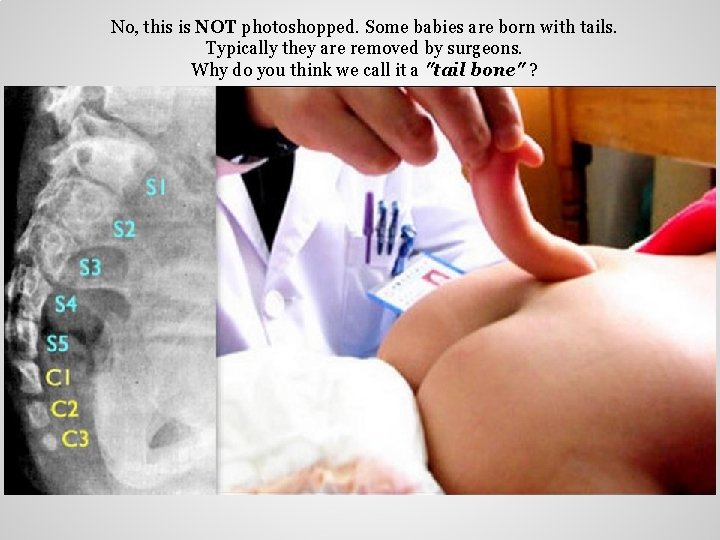 No, this is NOT photoshopped. Some babies are born with tails. Typically they are