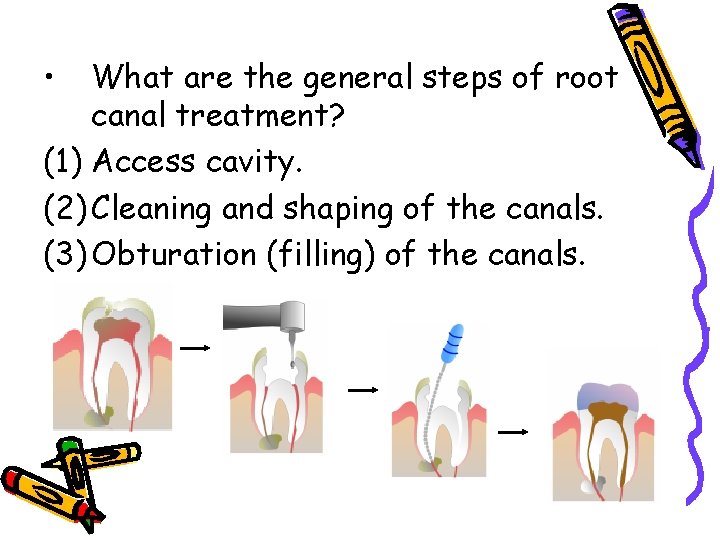  • What are the general steps of root canal treatment? (1) Access cavity.