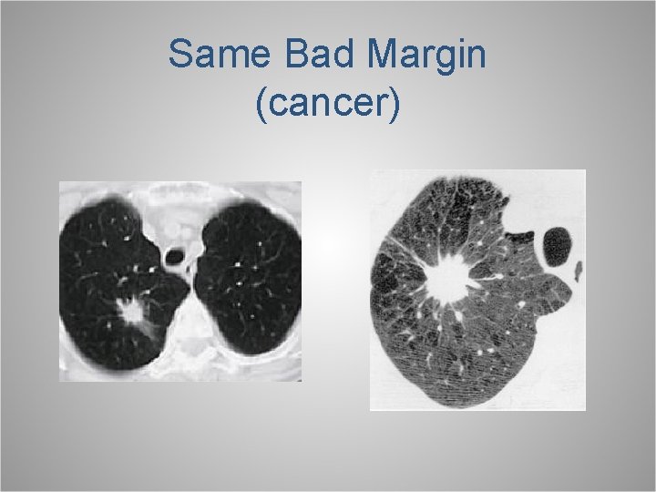 Same Bad Margin (cancer) 