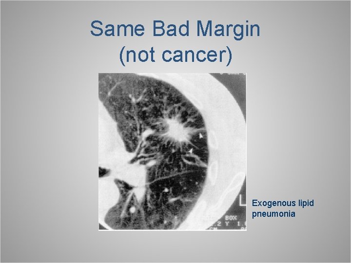 Same Bad Margin (not cancer) Exogenous lipid pneumonia 