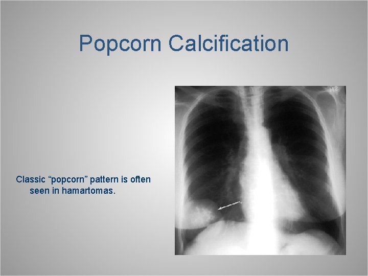Popcorn Calcification Classic “popcorn” pattern is often seen in hamartomas. 