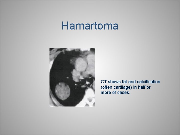 Hamartoma CT shows fat and calcification (often cartilage) in half or more of cases.