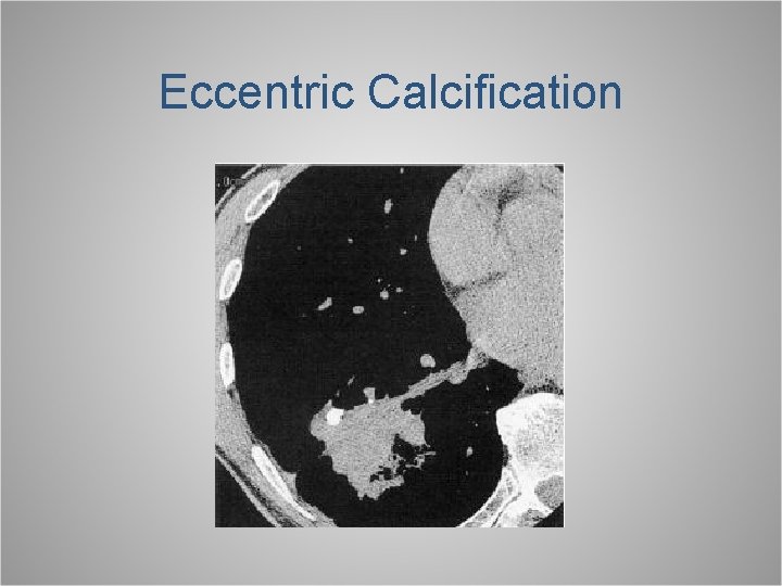 Eccentric Calcification 