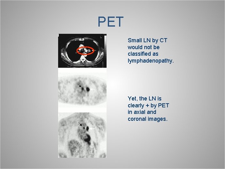 PET Small LN by CT would not be classified as lymphadenopathy. Yet, the LN