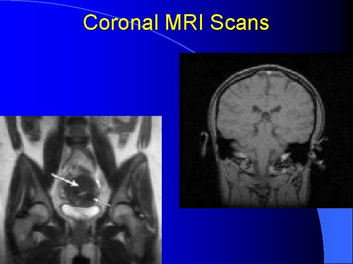 Coronal MRI Scans 