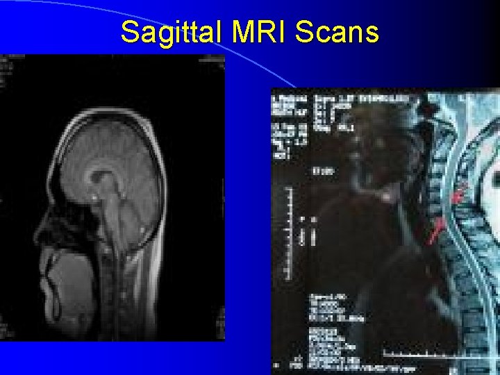 Sagittal MRI Scans 