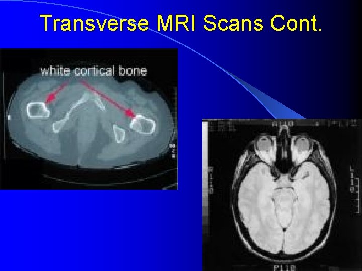 Transverse MRI Scans Cont. 