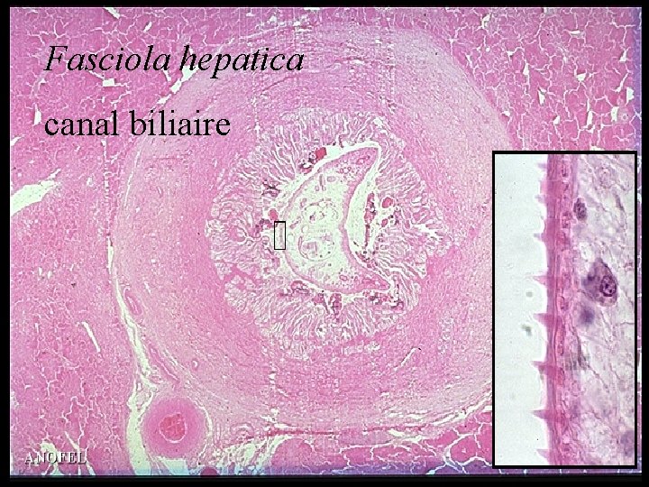 Fasciola hepatica canal biliaire 