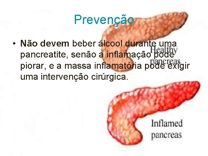 Prevenção • Não devem beber álcool durante uma pancreatite, senão a inflamação pode piorar,
