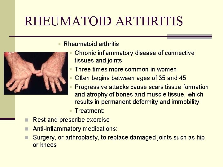 RHEUMATOID ARTHRITIS § Rheumatoid arthritis § Chronic inflammatory disease of connective tissues and joints
