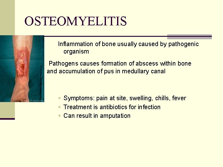 OSTEOMYELITIS Inflammation of bone usually caused by pathogenic organism Pathogens causes formation of abscess