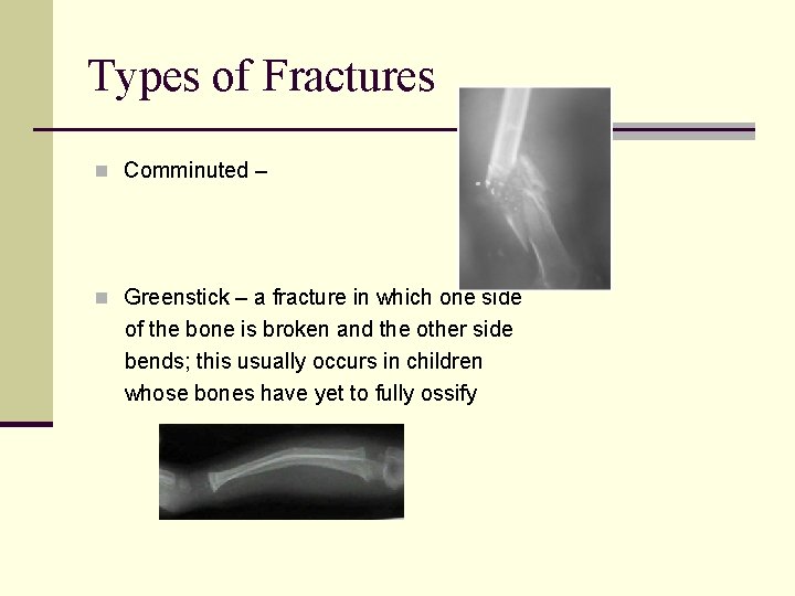 Types of Fractures n Comminuted – n Greenstick – a fracture in which one