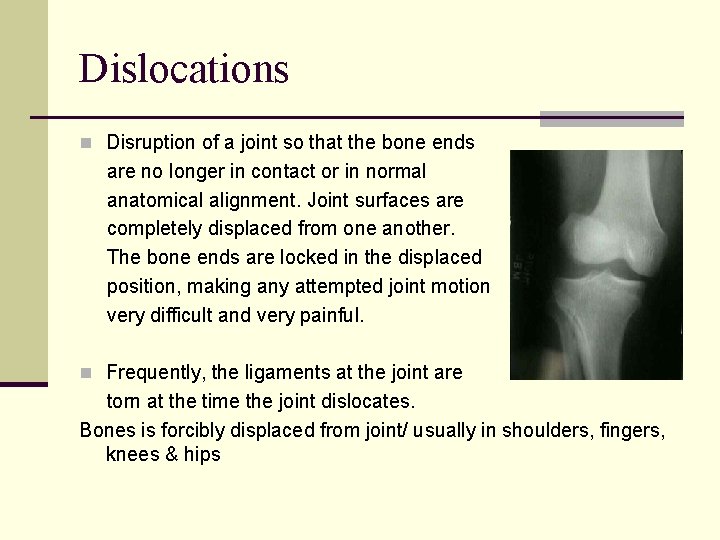 Dislocations n Disruption of a joint so that the bone ends are no longer