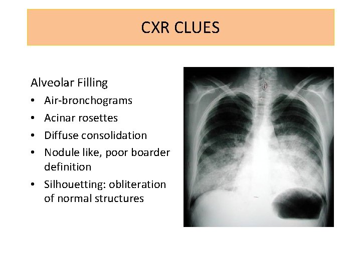 CXR CLUES Alveolar Filling Air-bronchograms Acinar rosettes Diffuse consolidation Nodule like, poor boarder definition