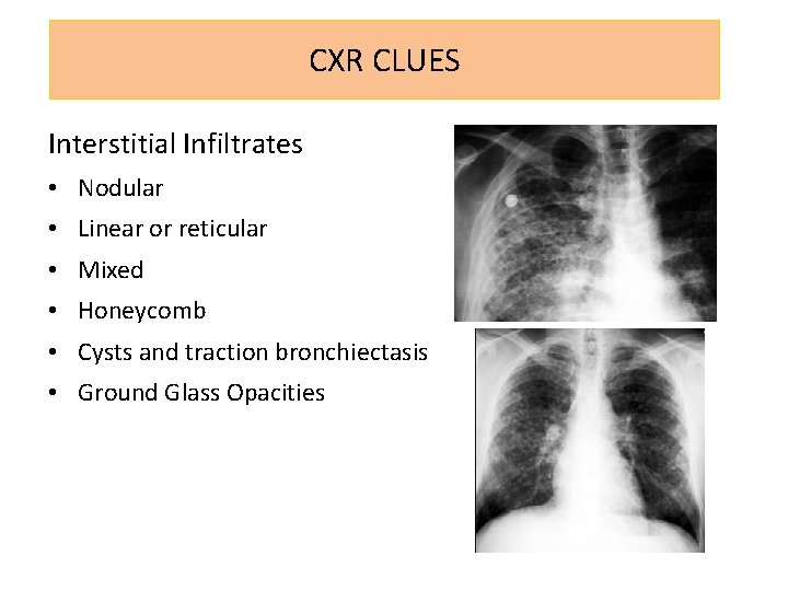 CXR CLUES Interstitial Infiltrates • Nodular • Linear or reticular • Mixed • Honeycomb