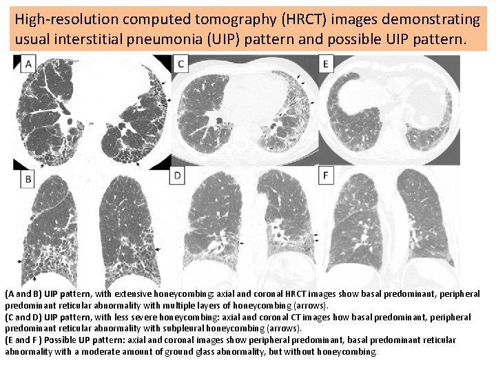High-resolution computed tomography (HRCT) images demonstrating usual interstitial pneumonia (UIP) pattern and possible UIP