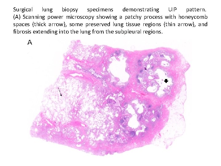 Surgical lung biopsy specimens demonstrating UIP pattern. (A) Scanning power microscopy showing a patchy Surgical lung biopsy specimens demonstrating UIP pattern. (A) Scanning power microscopy showing a patchy