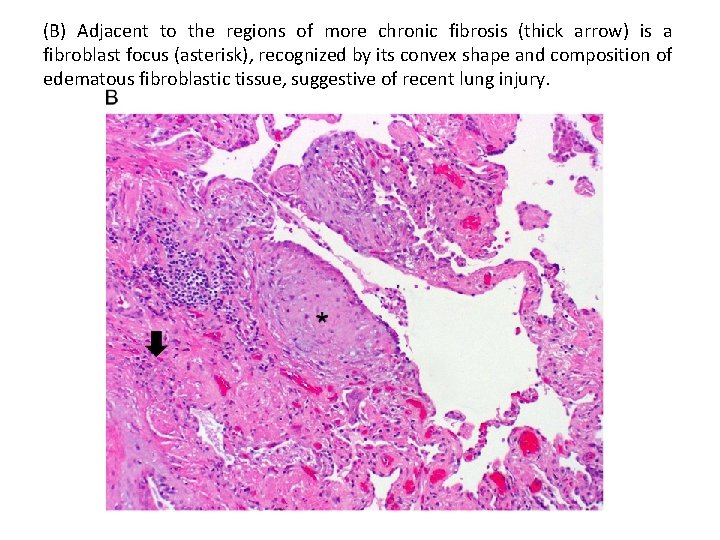 (B) Adjacent to the regions of more chronic fibrosis (thick arrow) is a fibroblast