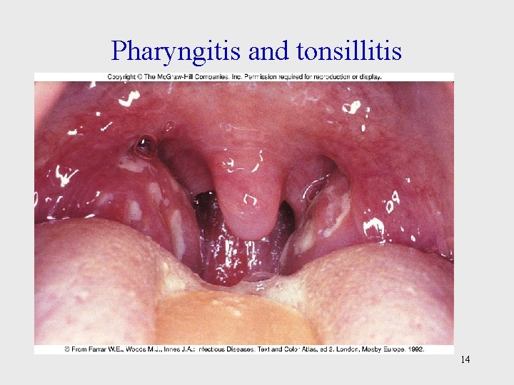 Pharyngitis and tonsillitis 14 