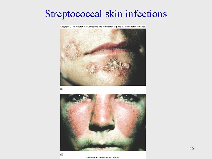 Streptococcal skin infections 15 