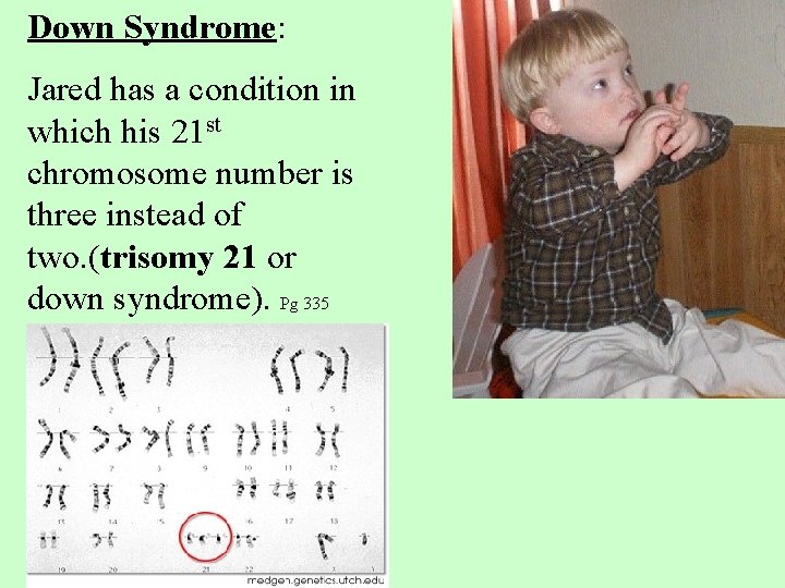 Down Syndrome: Jared has a condition in which his 21 st chromosome number is