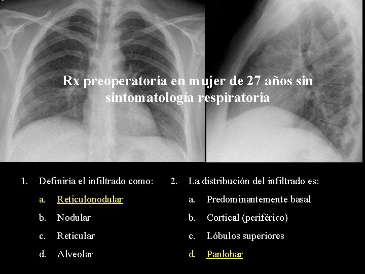 Rx preoperatoria en mujer de 27 años sintomatología respiratoria 1. Definiría el infiltrado como: