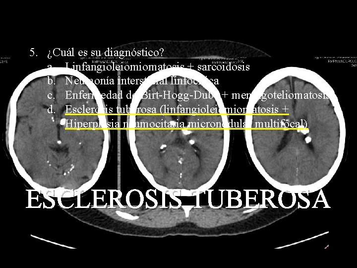 5. ¿Cuál es su diagnóstico? a. Linfangioleiomiomatosis + sarcoidosis b. Neumonía intersticial linfocítica c.