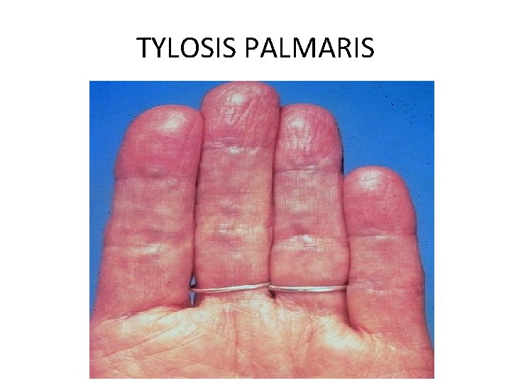 TYLOSIS PALMARIS 
