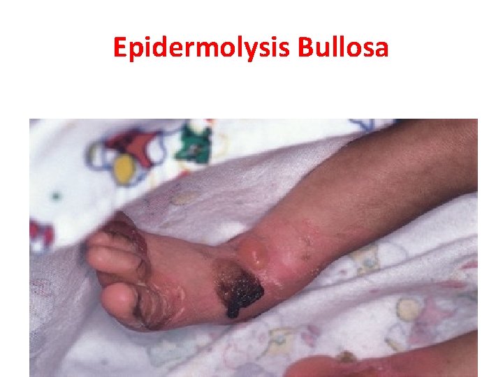 Epidermolysis Bullosa 