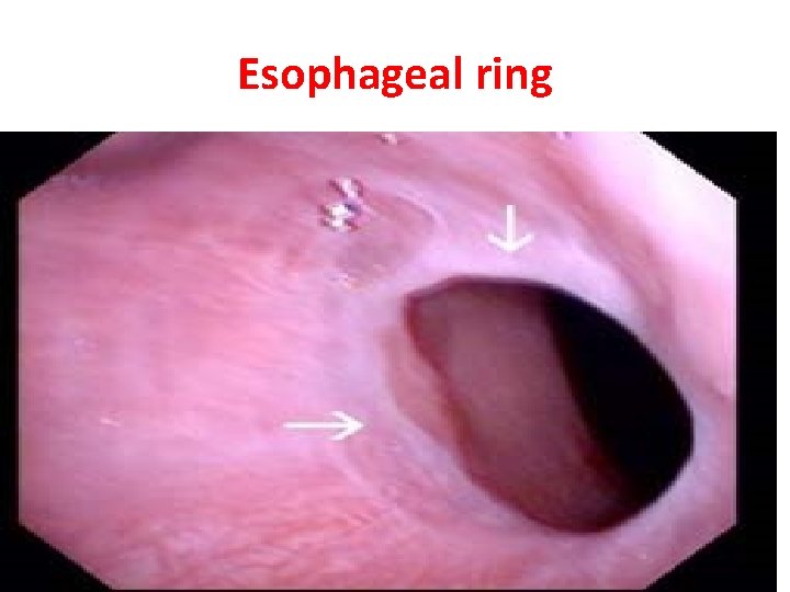 Esophageal ring 
