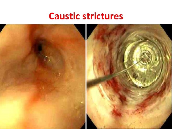 Caustic strictures Caustic strictures