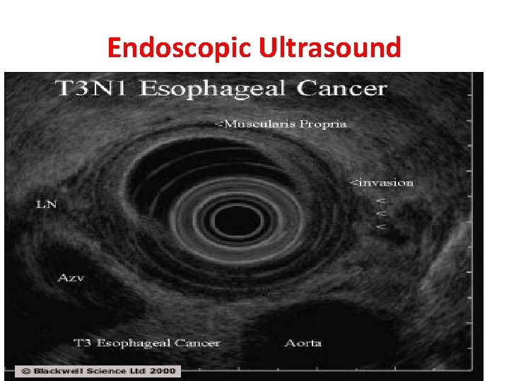 Endoscopic Ultrasound 