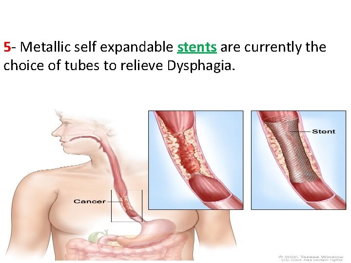 5 - Metallic self expandable stents are currently the choice of tubes to relieve