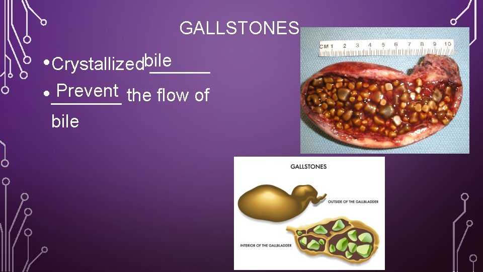 GALLSTONES • Crystallizedbile ______ Prevent the flow of • _______ bile 