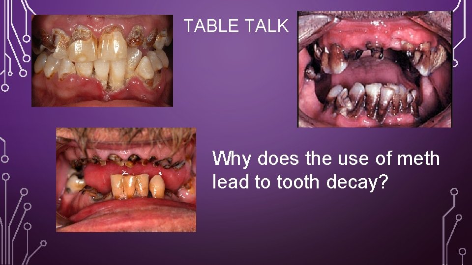 TABLE TALK Why does the use of meth lead to tooth decay? 
