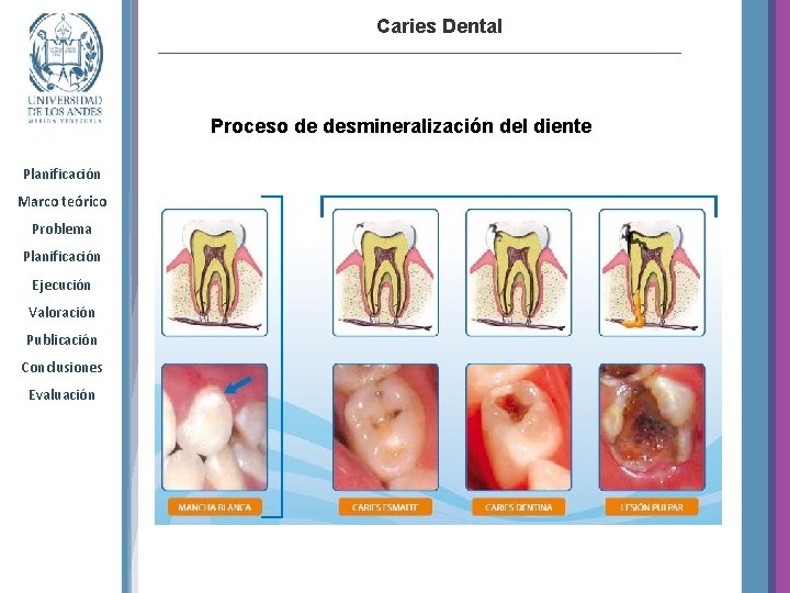 Caries Dental Proceso de desmineralización del diente Planificación Marco teórico Problema Planificación Ejecución Valoración