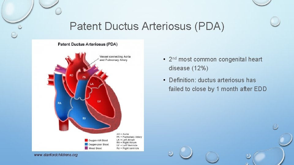 Patent Ductus Arteriosus (PDA) • 2 nd most common congenital heart disease (12%) •