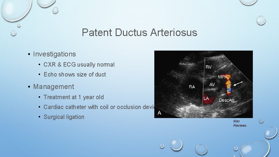 Patent Ductus Arteriosus • Investigations • CXR & ECG usually normal • Echo shows