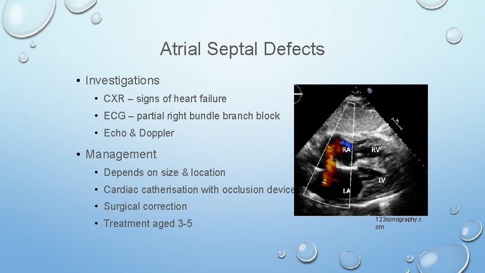 Atrial Septal Defects • Investigations • CXR – signs of heart failure • ECG