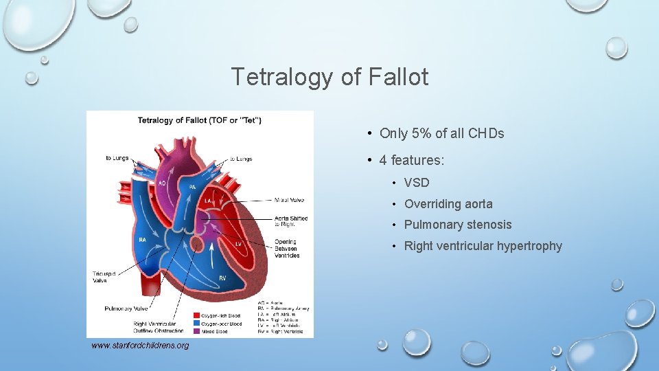 Tetralogy of Fallot • Only 5% of all CHDs • 4 features: • VSD