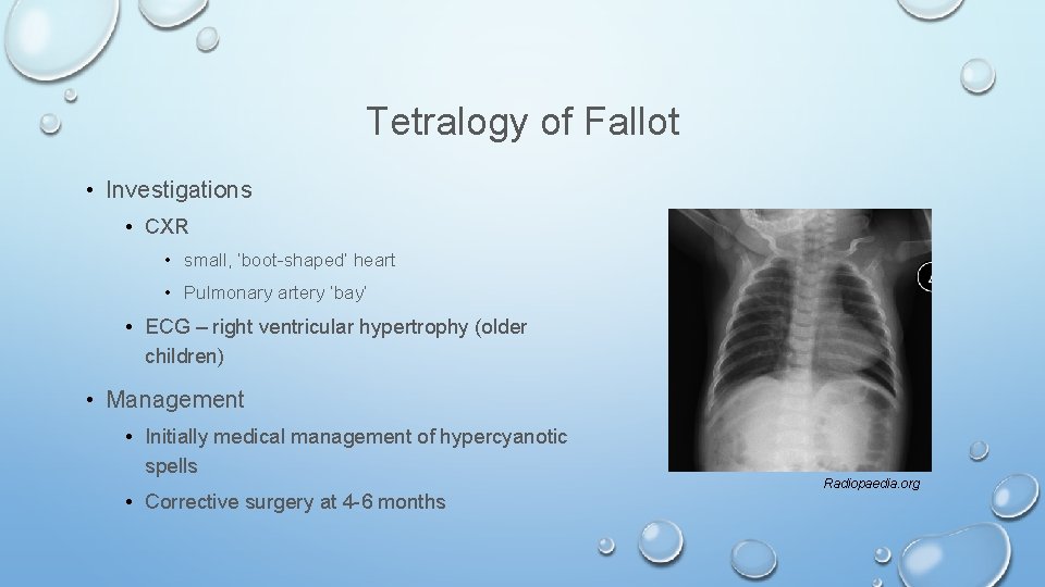Tetralogy of Fallot • Investigations • CXR • small, ‘boot-shaped’ heart • Pulmonary artery