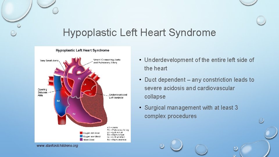 Hypoplastic Left Heart Syndrome • Underdevelopment of the entire left side of the heart