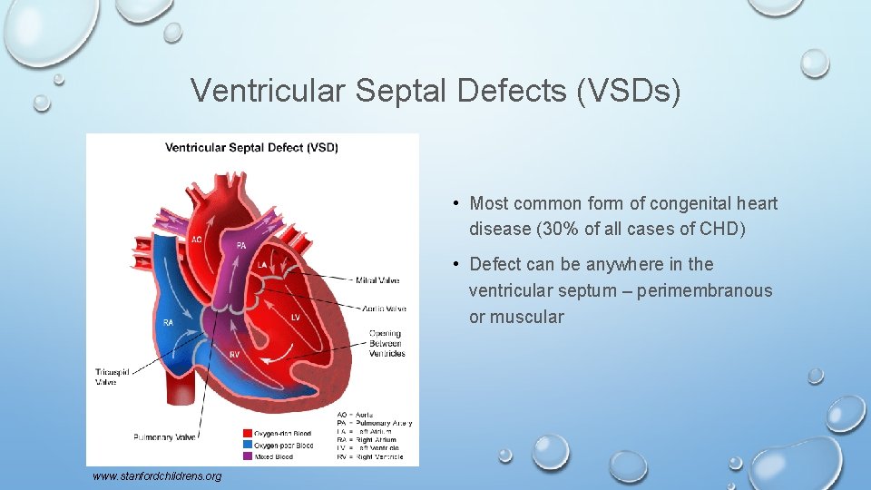 Ventricular Septal Defects (VSDs) • Most common form of congenital heart disease (30% of