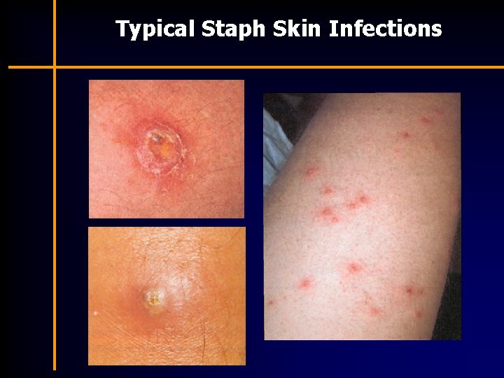 Typical Staph Skin Infections 